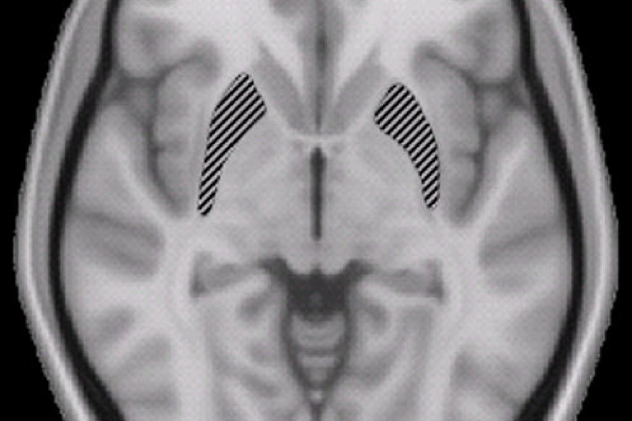 A top down brain scan in black and white.